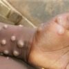 US DONATES 10,000 MPOX VACCINE DOSES TO NIGERIA